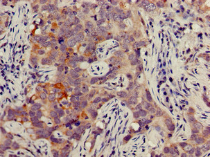 JAG1 / Jagged 1 Antibody - Immunohistochemistry of paraffin-embedded human pancreatic cancer using JAG1 Antibody at dilution of 1:100