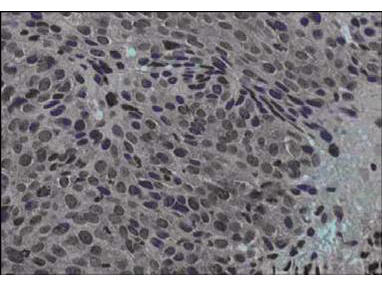 JAG1 / Jagged 1 Antibody - Immunohistochemical staining of human cervical cancer tissue (40X magnification) using the Protein A purified anti-Jagged-1 antibody. Tissue was fixed with formalin and embedded in paraffin. Hematoxylin was used to counter-stain cells. A 1:100 dilution of primary antibody was used.