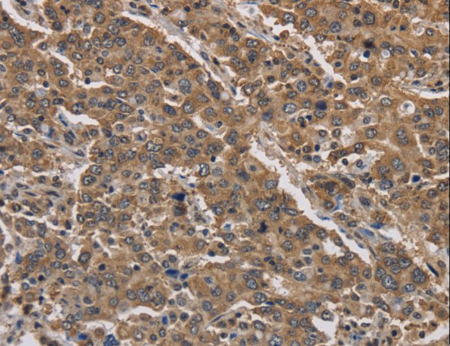 JAG2 / Jagged-2 Antibody - Immunohistochemistry of paraffin-embedded Human liver cancer using JAG2 Polyclonal Antibody at dilution of 1:30.
