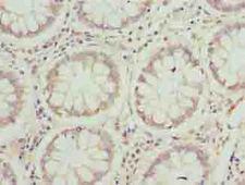 JAGN1 Antibody - Immunohistochemistry of paraffin-embedded human colon cancer using antibody at dilution of 1:100.