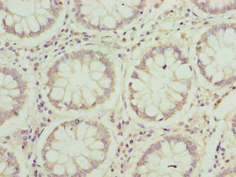JAGN1 Antibody - Immunohistochemistry of paraffin-embedded human colon cancer using JAGN1 Antibody at dilution of 1:100