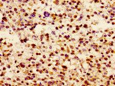JAM3 Antibody - Immunohistochemistry image of paraffin-embedded human glioma cancer at a dilution of 1:100