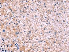 JAM3 Antibody - Immunohistochemistry of paraffin-embedded Human liver cancer tissue  using JAM3 Polyclonal Antibody at dilution of 1:40(×200)