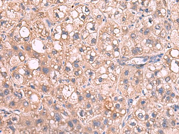 JAZF1 Antibody - Immunohistochemistry of paraffin-embedded Human liver cancer tissue  using JAZF1 Polyclonal Antibody at dilution of 1:55(×200)