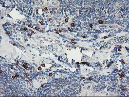 JCHAIN / Ig J Chain Antibody - IHC of paraffin-embedded Human lymphoma tissue using anti-IGJ mouse monoclonal antibody.