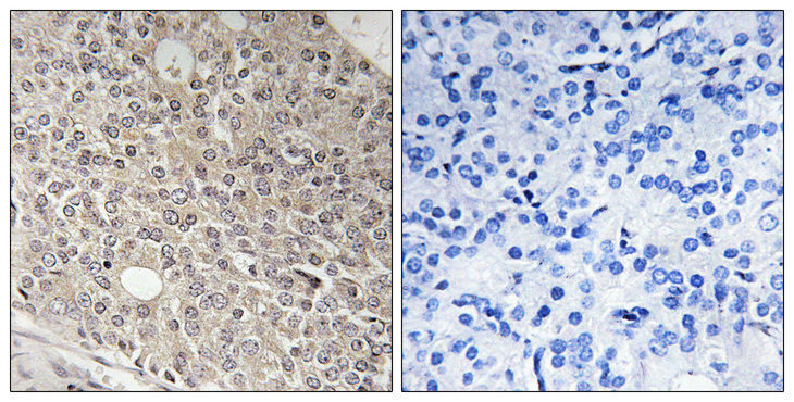 JEAP / AMOTL1 Antibody - Immunohistochemistry analysis of paraffin-embedded human prostate carcinoma tissue, using AMOTL1 Antibody. The picture on the right is blocked with the synthesized peptide.
