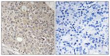 JEAP / AMOTL1 Antibody - Immunohistochemistry analysis of paraffin-embedded human prostate carcinoma tissue, using AMOTL1 Antibody. The picture on the right is blocked with the synthesized peptide.