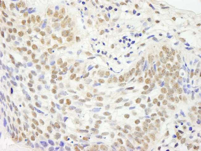 JHDM1A / KDM2A Antibody - Detection of Human JHDM1A Immunohistochemistry. Sample: FFPE section of human skin basal cell carcinoma. Antibody: Affinity purified rabbit anti-JHDM1A used at a dilution of 1:250.