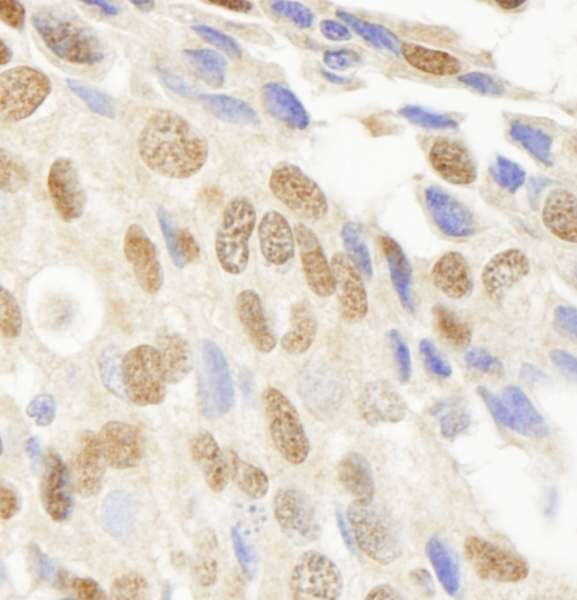 JHDM1A / KDM2A Antibody - Detection of Human JHDM1A Immunohistochemistry. Sample: FFPE section of human breast carcinoma. Antibody: Affinity purified rabbit anti-JHDM1A used at a dilution of 1:250.