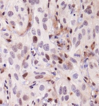JHDM1A / KDM2A Antibody - Immunohistochemistry: KDM2A/FBXL11 Antibody - IHC of KDM2A / FBXL11 in human kidney cancer xenograft using DAB with hematoxylin counterstain.  This image was taken for the unconjugated form of this product. Other forms have not been tested.