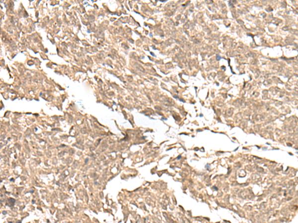 JHDM1A / KDM2A Antibody - Immunohistochemistry of paraffin-embedded Human lung cancer tissue  using KDM2A Polyclonal Antibody at dilution of 1:55(×200)