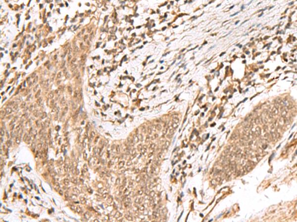 JHDM1A / KDM2A Antibody - Immunohistochemistry of paraffin-embedded Human esophagus cancer tissue  using KDM2A Polyclonal Antibody at dilution of 1:55(×200)