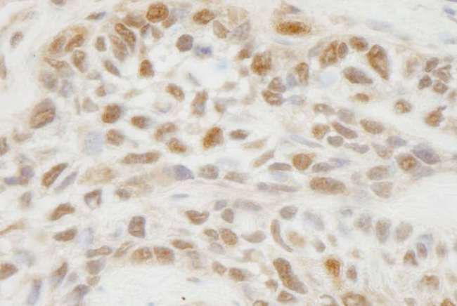 JMJD1C Antibody - Detection of Human JMJD1C by Immunohistochemistry. Sample: FFPE section of human laryngeal squamous cell carcinoma. Antibody: Affinity purified rabbit anti-JMJD1C used at a dilution of 1:100.