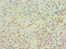 JMJD6 / PSR Antibody - Immunohistochemistry of paraffin-embedded human breast cancer using antibody at 1:100 dilution.