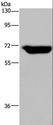 JMJD6 / PSR Antibody - Western blot analysis of Human breast infiltrative duct tissue, using JMJD6 Polyclonal Antibody at dilution of 1:425.
