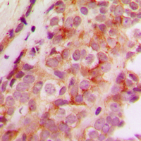 JMY Antibody - Immunohistochemical analysis of JMY staining in human breast cancer formalin fixed paraffin embedded tissue section. The section was pre-treated using heat mediated antigen retrieval with sodium citrate buffer (pH 6.0). The section was then incubated with the antibody at room temperature and detected using an HRP conjugated compact polymer system. DAB was used as the chromogen. The section was then counterstained with hematoxylin and mounted with DPX.