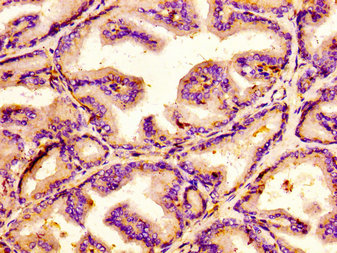 JMY Antibody - Immunohistochemistry image at a dilution of 1:100 and staining in paraffin-embedded human prostate tissue performed on a Leica BondTM system. After dewaxing and hydration, antigen retrieval was mediated by high pressure in a citrate buffer (pH 6.0) . Section was blocked with 10% normal goat serum 30min at RT. Then primary antibody (1% BSA) was incubated at 4 °C overnight. The primary is detected by a biotinylated secondary antibody and visualized using an HRP conjugated SP system.