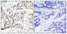 JNK1+2+3 Antibody - Immunohistochemistry analysis of paraffin-embedded human breast carcinoma, using SAPK/JNK (Phospho-Thr183) Antibody. The picture on the right is blocked with the phospho peptide.