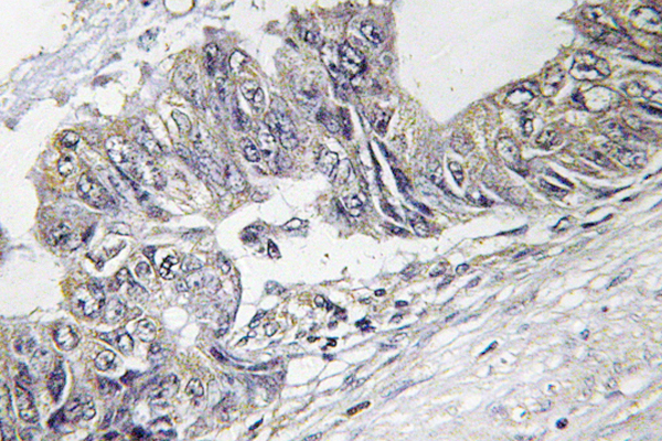 JNK1+2+3 Antibody - IHC of p-JNK1/2/3 (T183) pAb in paraffin-embedded human colon carcinoma tissue.