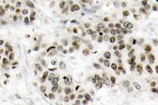 JNK1+2+3 Antibody - IHC of JNK1/2/3 (Y185) pAb in paraffin-embedded human breast carcinoma tissue.