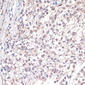 JNK1/2 Antibody - Immunohistochemistry of paraffin-embedded Human gastric cancer using c-Jun Polyclonal Antibody at dilution of 1:100 (40x lens).