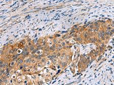 JOSD1 Antibody - Immunohistochemistry of paraffin-embedded Human cervical cancer tissue  using JOSD1 Polyclonal Antibody at dilution of 1:70(×200)