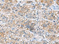 JOSD1 Antibody - Immunohistochemistry of paraffin-embedded Human liver cancer tissue  using JOSD1 Polyclonal Antibody at dilution of 1:90(×200)