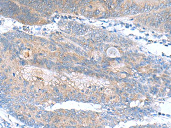 JOSD1 Antibody - Immunohistochemistry of paraffin-embedded Human colorectal cancer tissue  using JOSD1 Polyclonal Antibody at dilution of 1:90(×200)