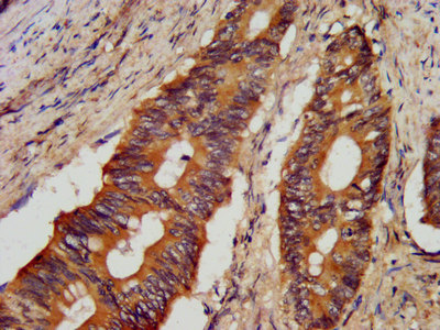 JPH1 Antibody - Immunohistochemistry image at a dilution of 1:300 and staining in paraffin-embedded human colon cancer performed on a Leica BondTM system.