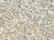 JPH1 Antibody - Immunohistochemistry of paraffin-embedded Human liver cancer tissue  using JPH1 Polyclonal Antibody at dilution of 1:30(×200)
