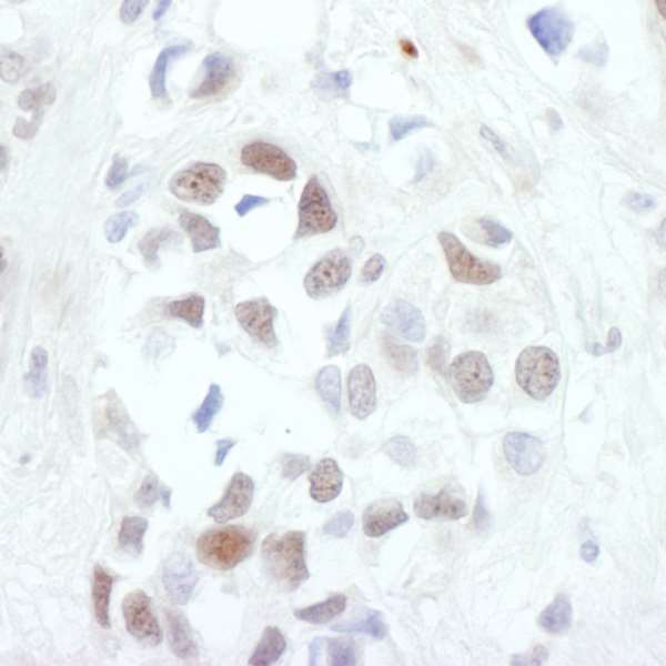 JUN / c-Jun Antibody - Detection of Human c-Jun by Immunohistochemistry. Sample: FFPE section of human breast carcinoma. Antibody: Affinity purified rabbit anti-c-Jun used at a dilution of 1:200 (1 ug/ml). Detection: DAB.
