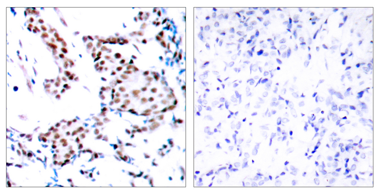JUN / c-Jun Antibody - Immunohistochemistry analysis of paraffin-embedded human breast carcinoma tissue, using c-Jun Antibody. The picture on the right is blocked with the synthesized peptide.