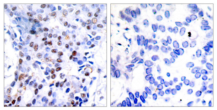 JUN / c-Jun Antibody - Immunohistochemistry analysis of paraffin-embedded human breast carcinoma tissue, using c-Jun Antibody. The picture on the right is blocked with the synthesized peptide.