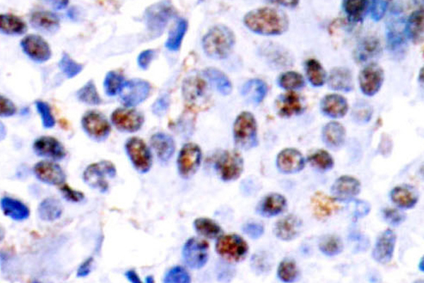 JUN / c-Jun Antibody - IHC of c-Jun (N85) pAb in paraffin-embedded human breast carcinoma tissue.