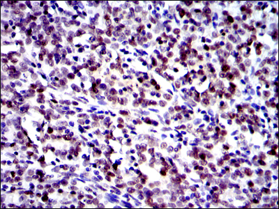 JUN / c-Jun Antibody - IHC of paraffin-embedded cervical cancer tissues using c-Jun mouse monoclonal antibody with DAB staining.