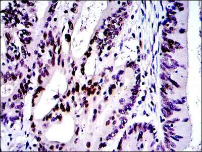 JUN / c-Jun Antibody - IHC of paraffin-embedded colon cancer tissues using c-Jun mouse monoclonal antibody with DAB staining.