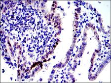 JUN / c-Jun Antibody - IHC of paraffin-embedded human intima cancer tissues using c-Jun mouse monoclonal antibody with DAB staining.