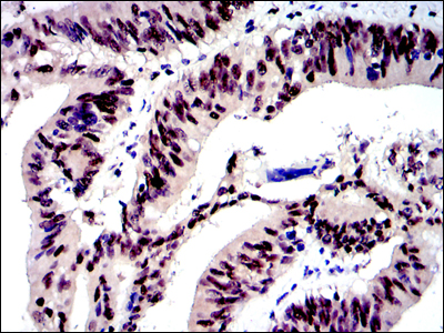 JUN / c-Jun Antibody - IHC of paraffin-embedded human rectum cancer tissues using c-Jun mouse monoclonal antibody with DAB staining.