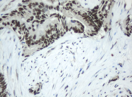 JUN / c-Jun Antibody - IHC of paraffin-embedded Adenocarcinoma of Human colon tissue using anti-JUN mouse monoclonal antibody. (Heat-induced epitope retrieval by 10mM citric buffer, pH6.0, 100C for 10min).