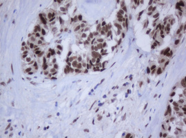 JUN / c-Jun Antibody - IHC of paraffin-embedded Carcinoma of Human pancreas tissue using anti-JUN mouse monoclonal antibody.