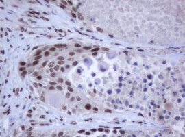 JUN / c-Jun Antibody - IHC of paraffin-embedded Carcinoma of Human lung tissue using anti-JUN mouse monoclonal antibody.
