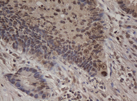 JUN / c-Jun Antibody - IHC of paraffin-embedded Adenocarcinoma of Human colon tissue using anti-JUN mouse monoclonal antibody.
