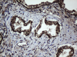 JUN / c-Jun Antibody - IHC of paraffin-embedded Carcinoma of Human prostate tissue using anti-JUN mouse monoclonal antibody.