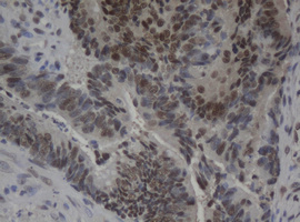 JUN / c-Jun Antibody - IHC of paraffin-embedded Adenocarcinoma of Human colon tissue using anti-JUN mouse monoclonal antibody.