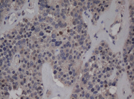 JUN / c-Jun Antibody - IHC of paraffin-embedded Carcinoma of Human pancreas tissue using anti-JUN mouse monoclonal antibody.