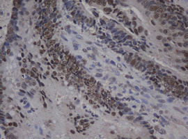 JUN / c-Jun Antibody - IHC of paraffin-embedded Adenocarcinoma of Human colon tissue using anti-JUN mouse monoclonal antibody.