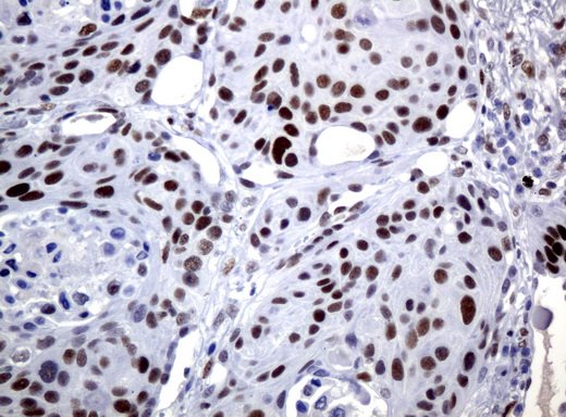 JUN / c-Jun Antibody - Immunohistochemical staining of paraffin-embedded Carcinoma of Human lung tissue using anti-JUN mouse monoclonal antibody.  heat-induced epitope retrieval by 10mM citric buffer, pH6.0, 120C for 3min)