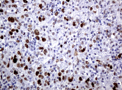 JUN / c-Jun Antibody - Immunohistochemical staining of paraffin-embedded Human lymphoma tissue using anti-JUN mouse monoclonal antibody.  heat-induced epitope retrieval by 10mM citric buffer, pH6.0, 120C for 3min)