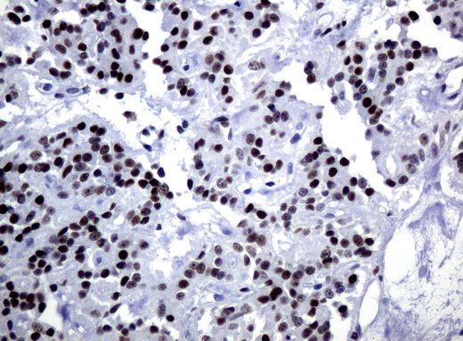 JUN / c-Jun Antibody - Immunohistochemical staining of paraffin-embedded Carcinoma of Human pancreas tissue using anti-JUN monoclonal antibody.  heat-induced epitope retrieval by 10mM citric buffer, pH6.0, 120C for 3min)
