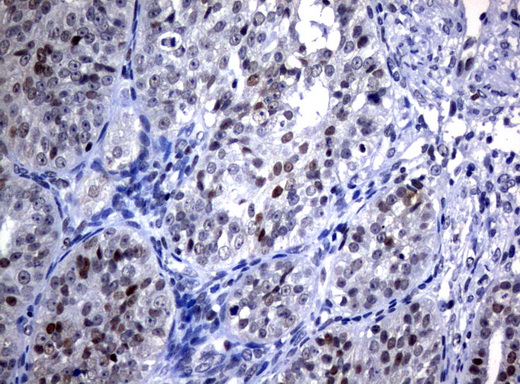 JUN / c-Jun Antibody - Immunohistochemical staining of paraffin-embedded Adenocarcinoma of Human ovary tissue using anti-JUN mouse monoclonal antibody.  heat-induced epitope retrieval by 10mM citric buffer, pH6.0, 120C for 3min)